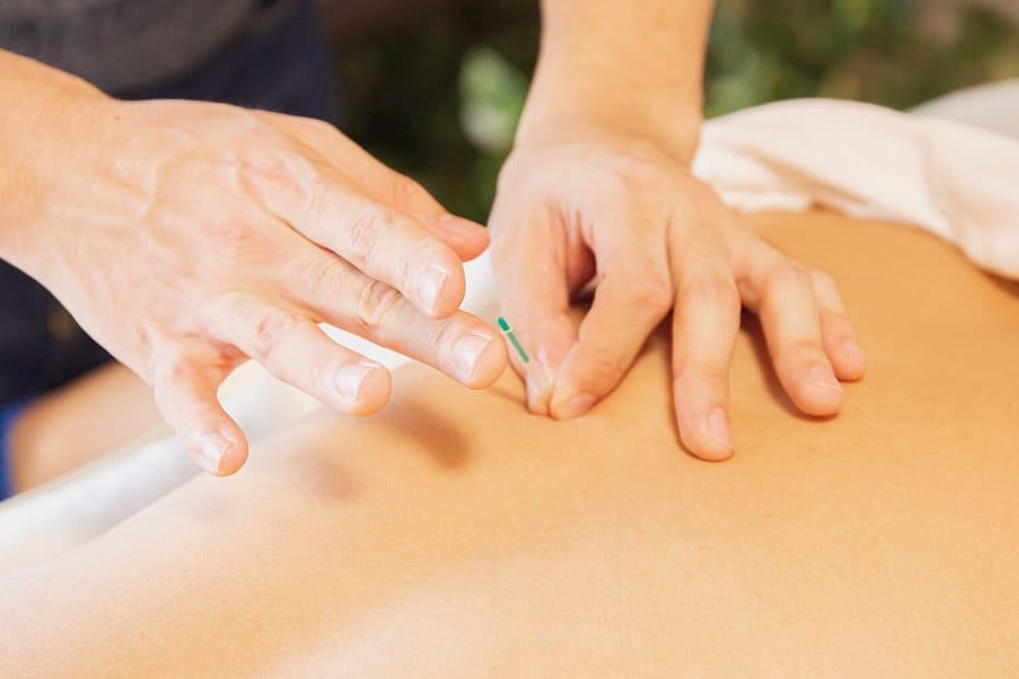 Dry Needling